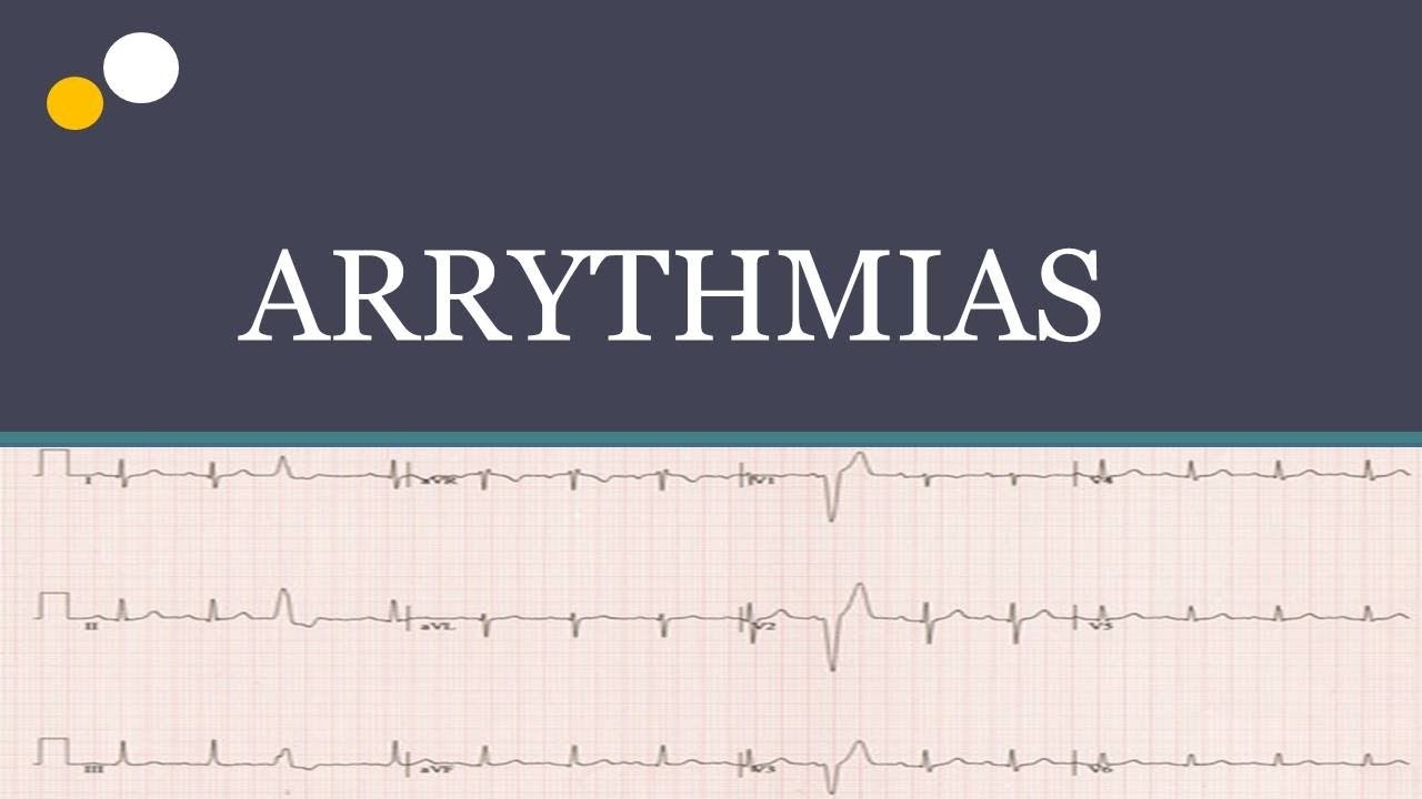 Arrhythmias types, cause, symptoms, pathophysiology and diagnosis 💖 ...