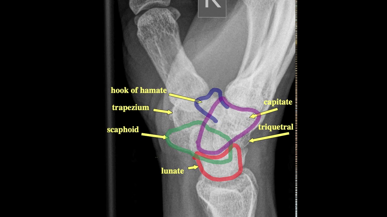 Radiographic Anatomy Of The Skeleton Wrist Lateral Vi - vrogue.co