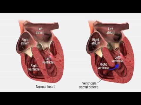 Cardiovascular Pathology - Heart Disease - YouTube