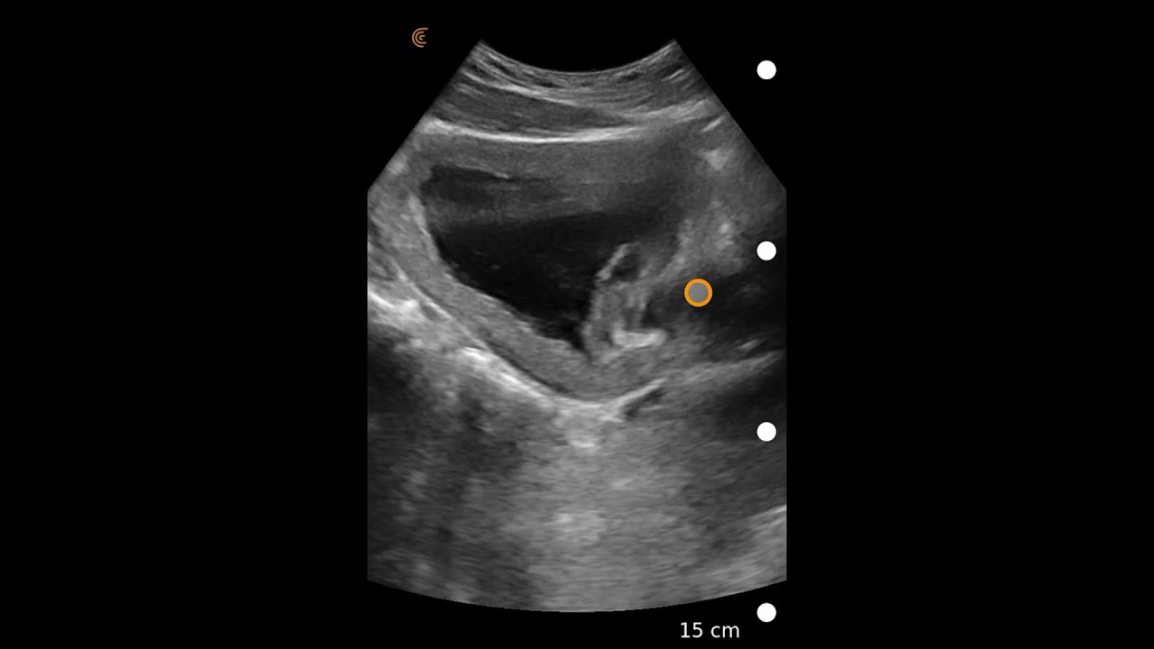 Normal Bladder Ultrasound