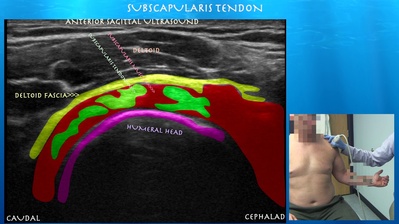 Subscapularis Ultrasound