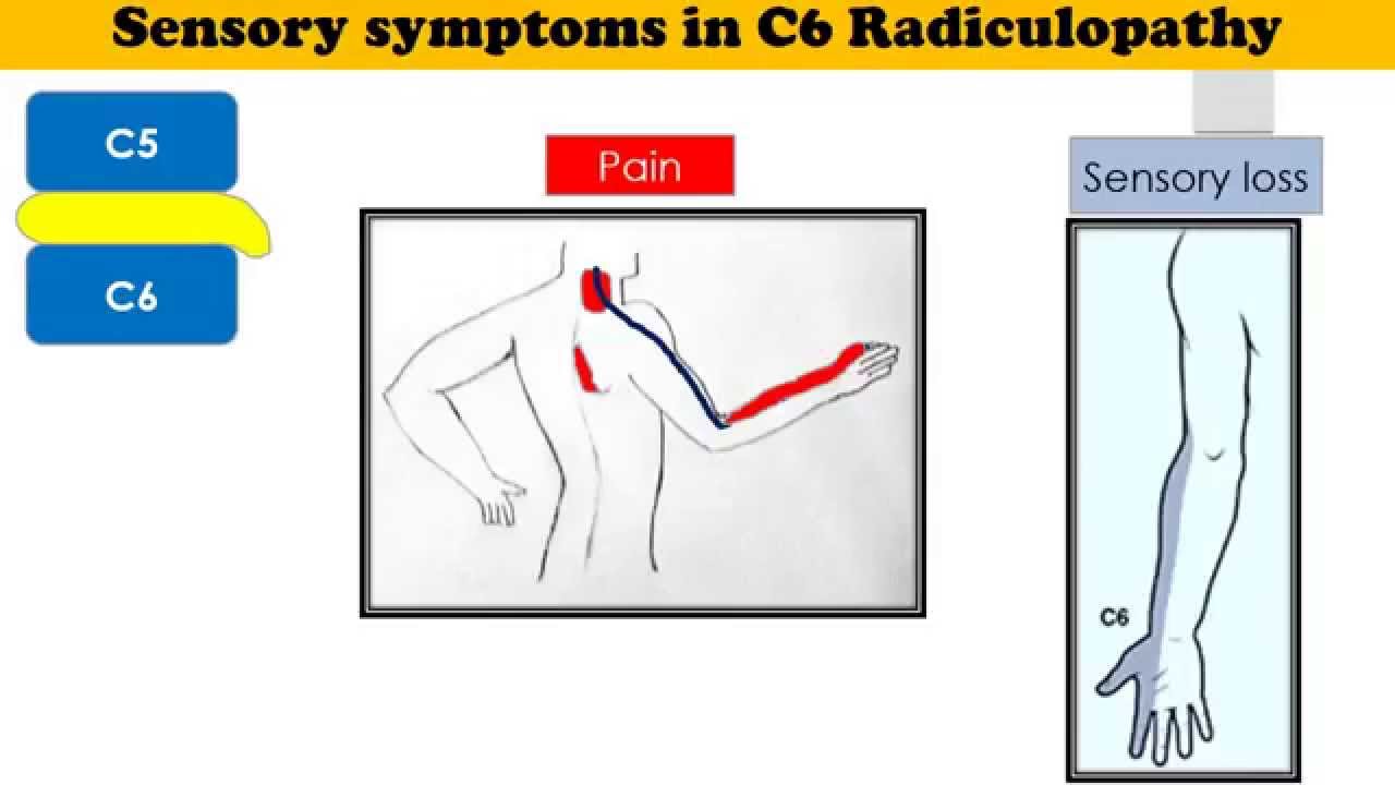 What Is C5 C6 Radiculopathy What Causes Cervical Radi - vrogue.co