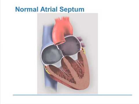 Patent Foramen Ovale (PFO) and Migraine - YouTube