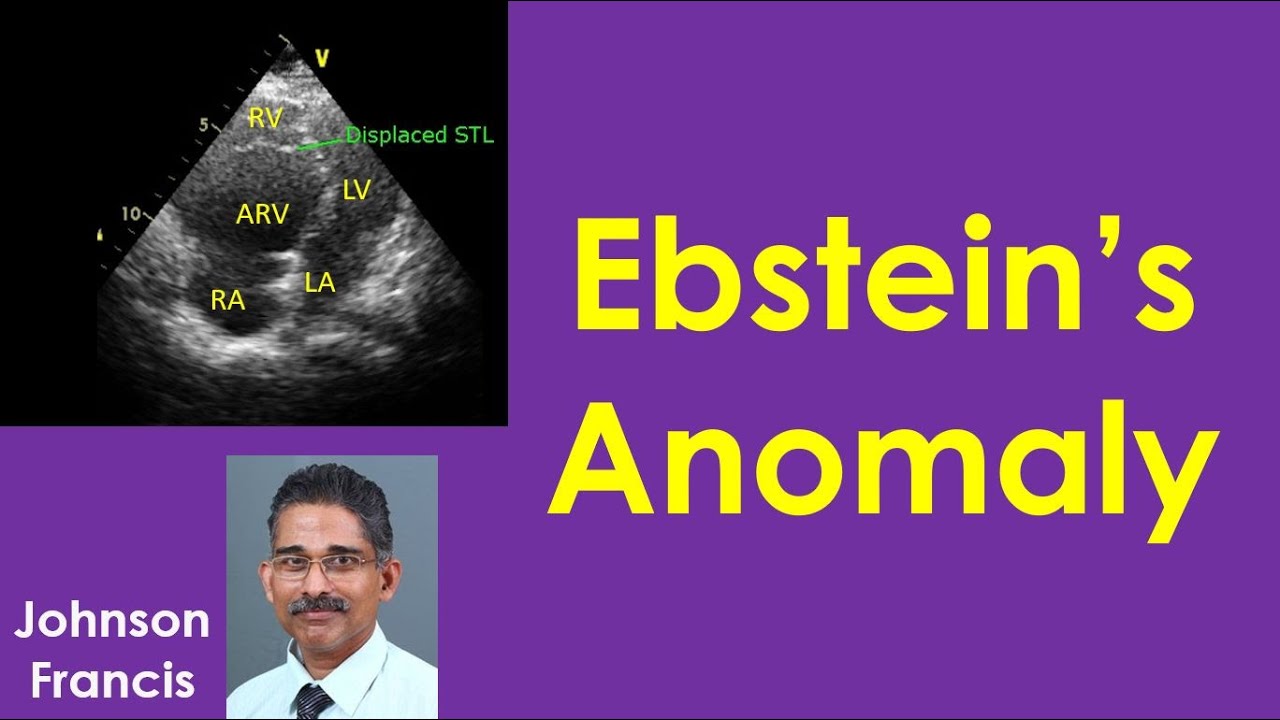 Ebstein's Anomaly - YouTube