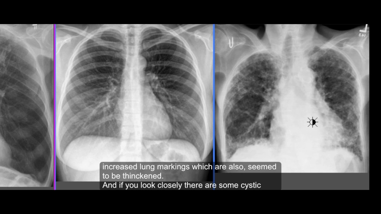 COPD Lungs Vs Normal Chest X Ray