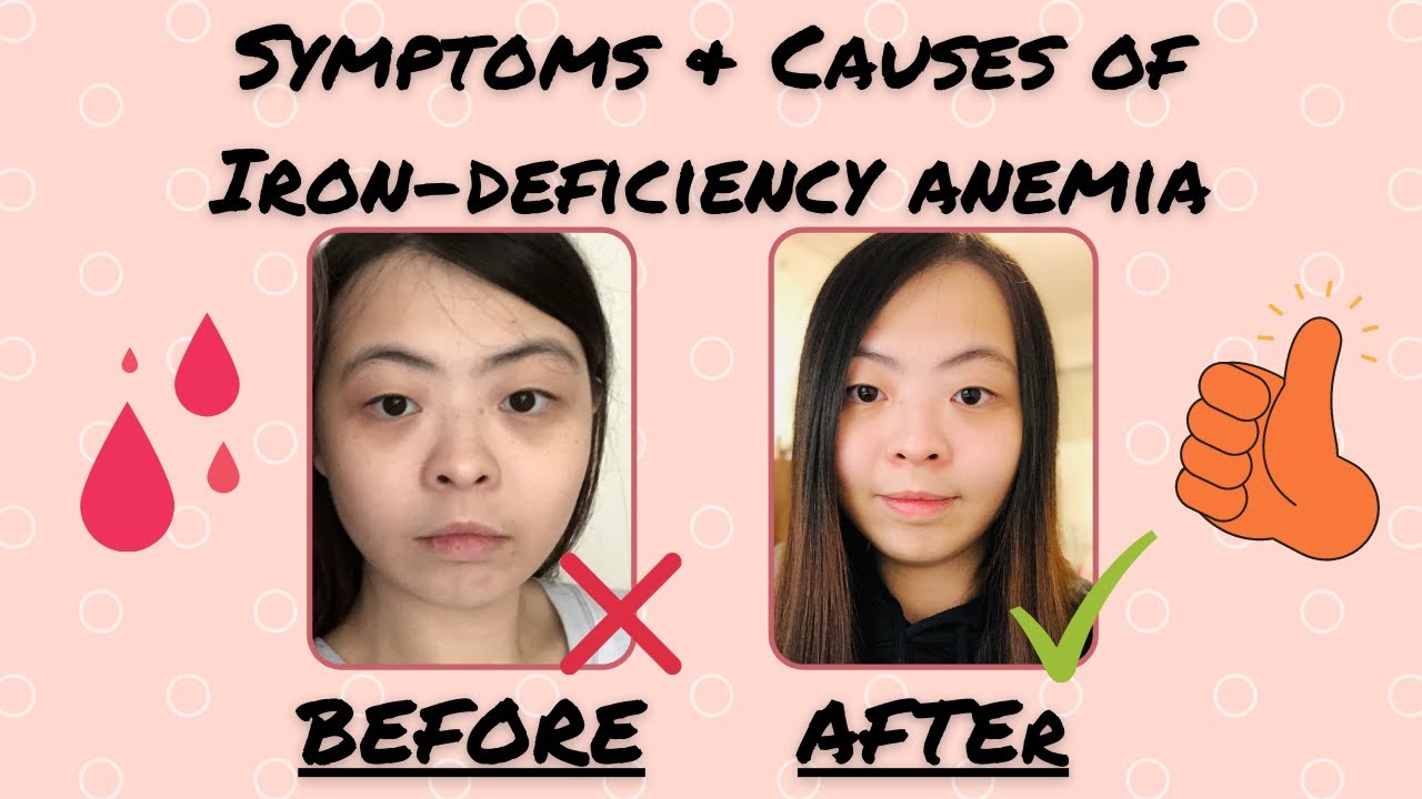 Iron Deficiency Anemia Symptoms