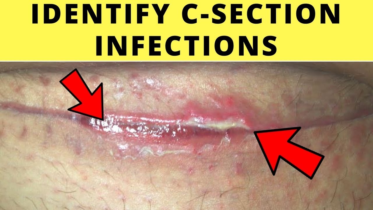 How to Get Rid of Yeast Infection on C-Section Scar - MyHealthGeek