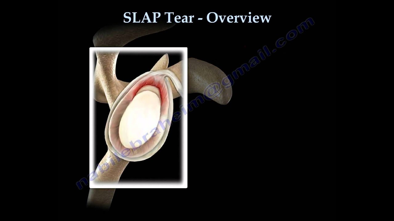 Bankart Lesion Vs Slap Tear