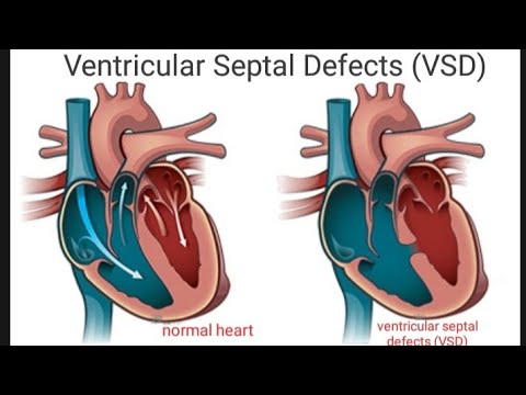 Ventricular Septal Defects (VSD)- (Types, Clinical manifestations ...