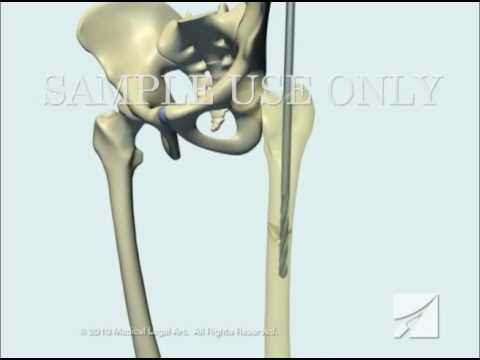 Femoral Fracture Fixation Surgery: Intramedullary Nail