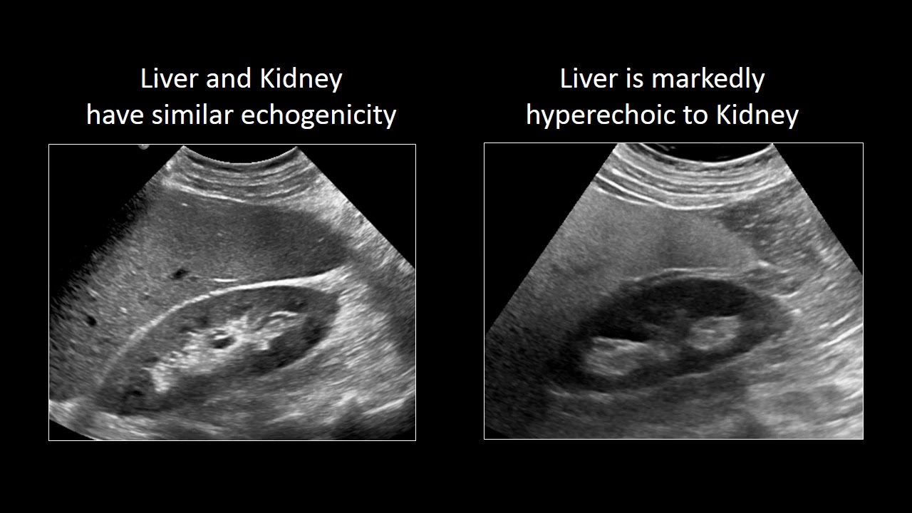 Normal Vs Fatty Liver Ultrasound