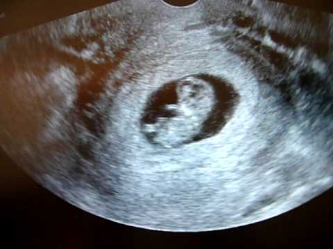 10 weeks pregnant ultrasound - YouTube