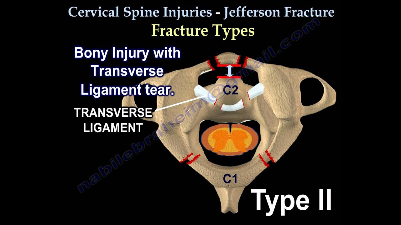 Occipital Condyle Fractures Everything You Need To Know