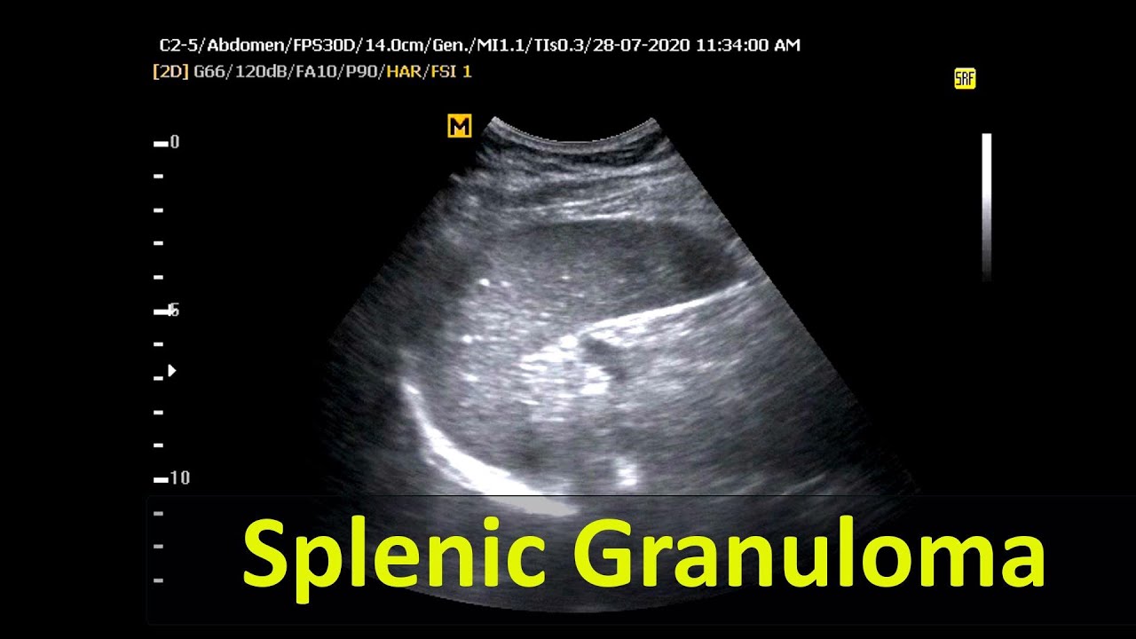 Ultrasound cases 28 of 2000 || Video Showing Abdominal Ultrasonography ...