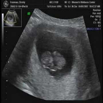 9 weeks 3 days - ultrasound - YouTube