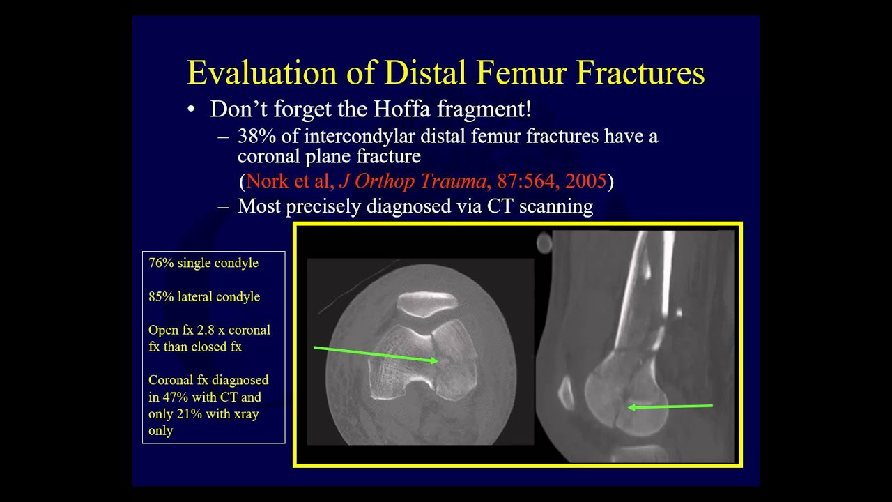 Distal Femur Anatomy