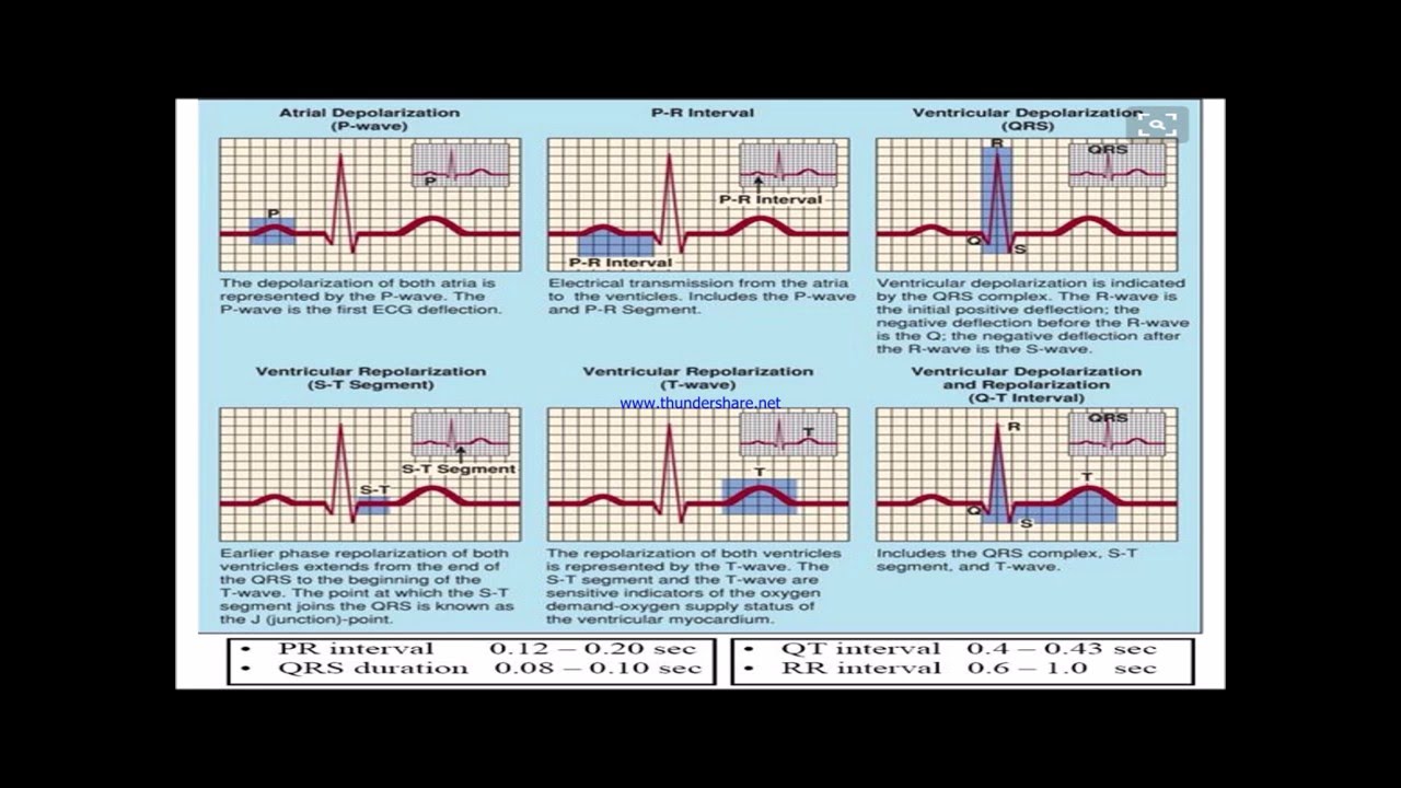 Abnormal Ecg Examples