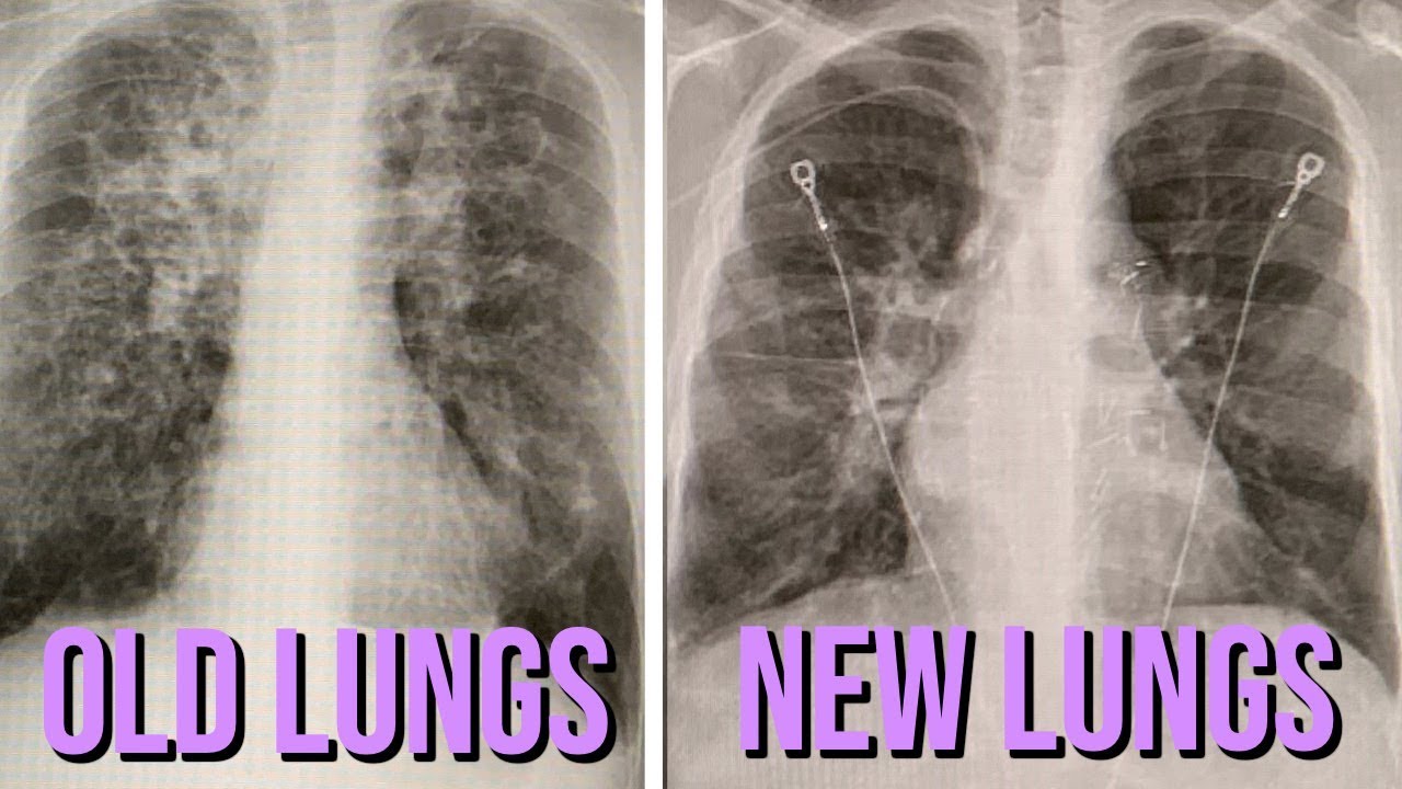 Cystic Fibrosis Lungs Vs Healthy Lungs