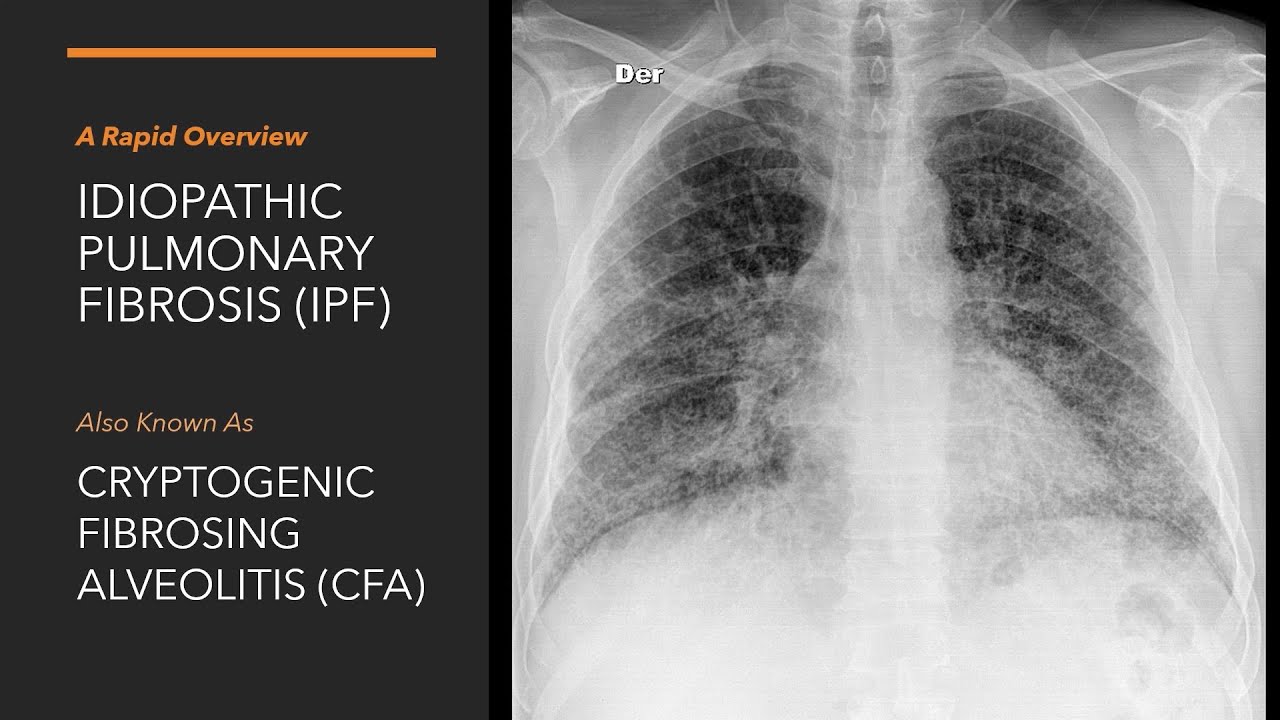 Chest X Ray Idiopathic Pulmonary Fibrosis Youtube - vrogue.co