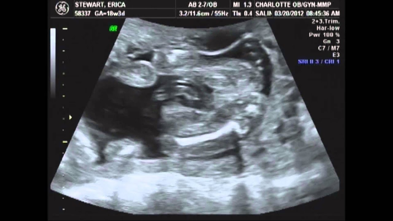 Weeks Sonogram Baby