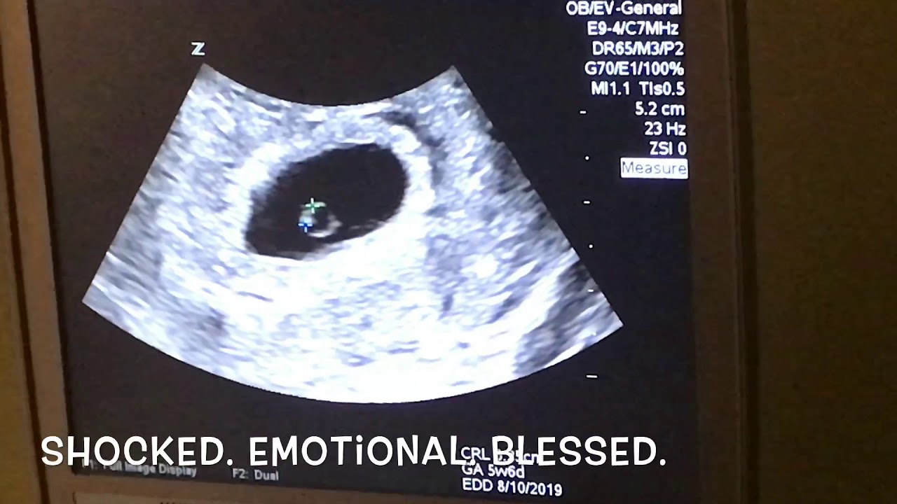 Twins Ultrasound 6 Weeks