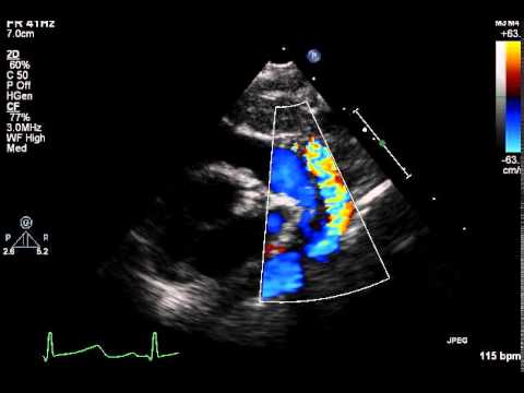 PLAX ductal view (2D with color) - YouTube