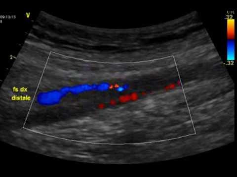 Femoral Artery Stenosis