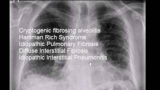 Pulmonary Fibrosis X Ray image.