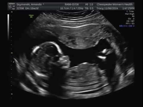 Ultrasound Twins 16 Weeks