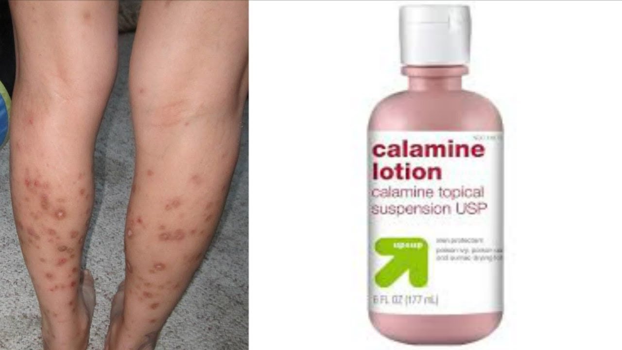 home-remedies-series-get-rid-of-dark-spots-on-legs-body-with