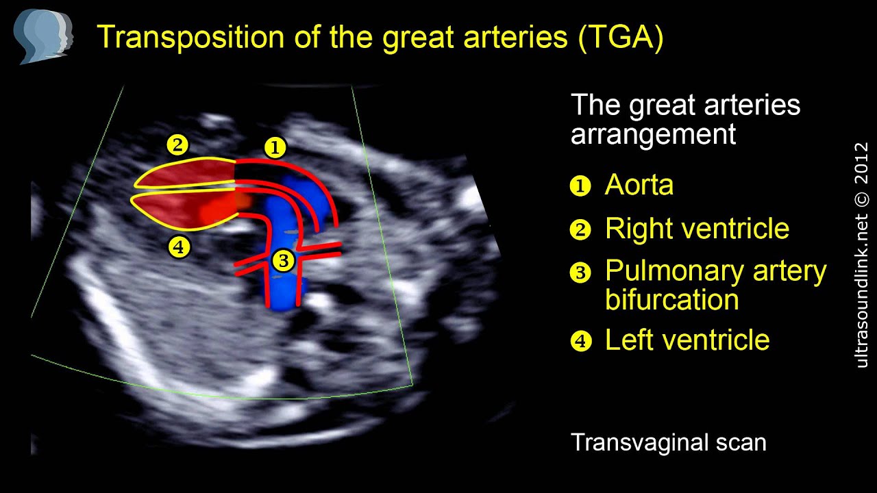 Transposition of the great arteries (TGA) - YouTube