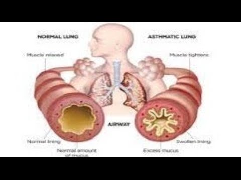 COPD - 1 Asthma 2 Emphysema 3 Bronchitis 4 Bronch - YouTube