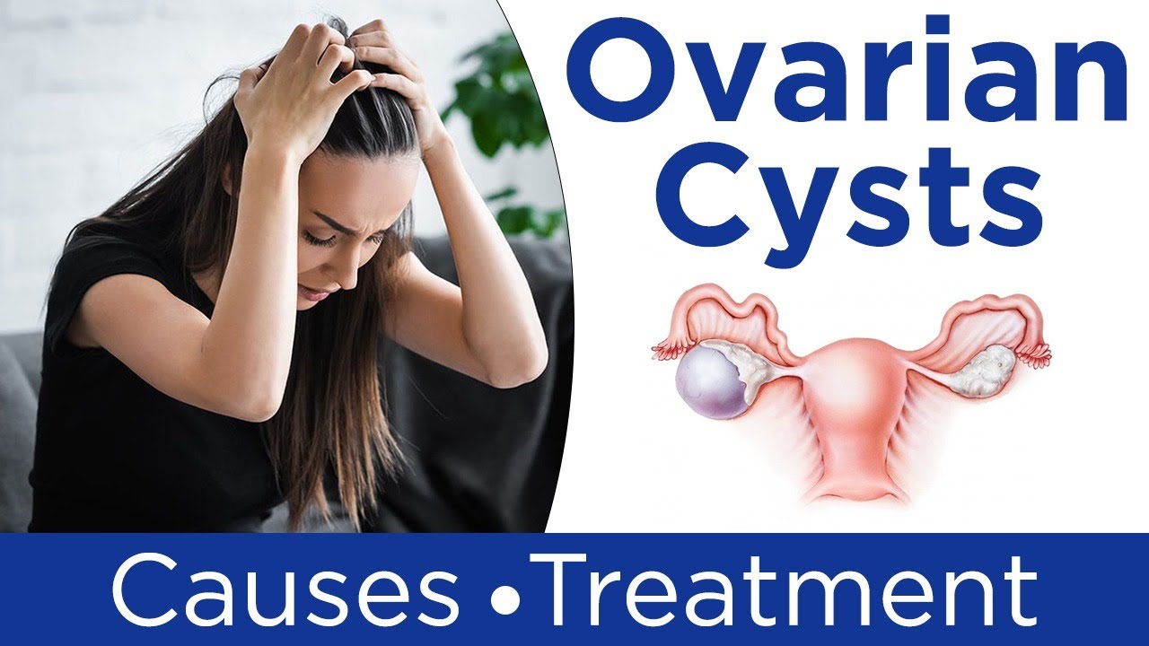 Ovarian Cyst: Causes, Symptoms And Treatment, 50% OFF