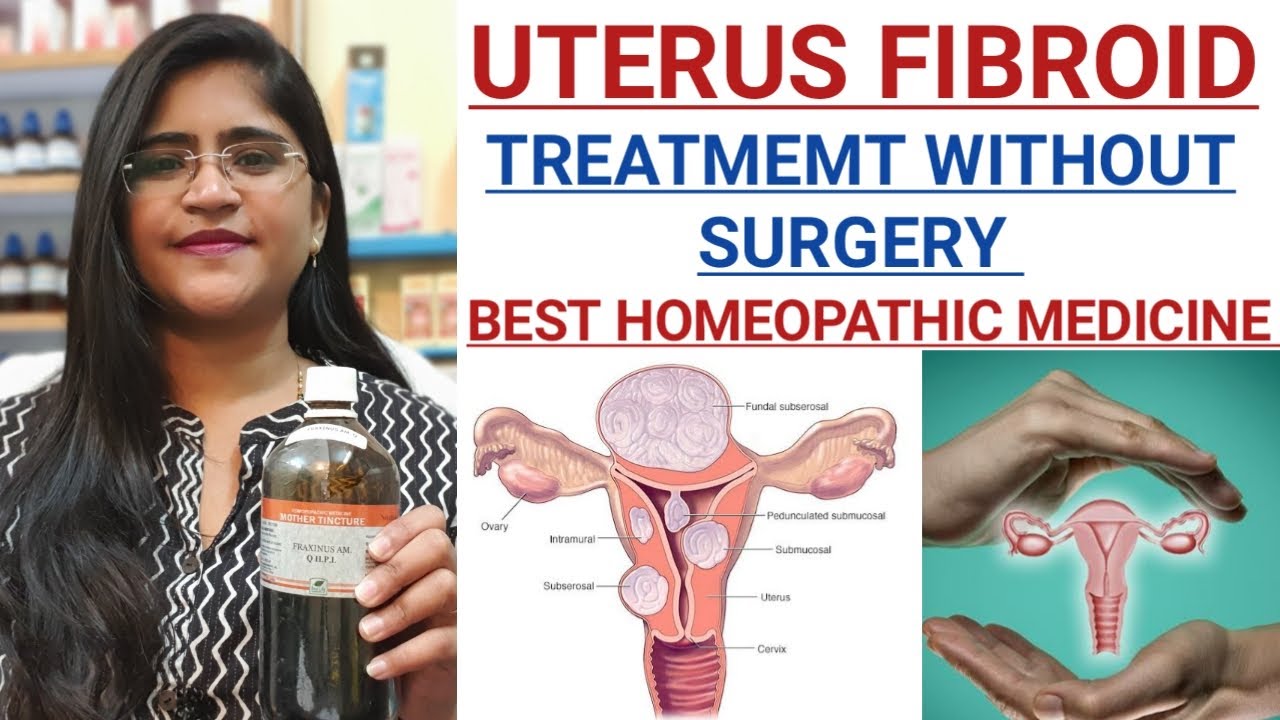 UTERINE FIBROID treatment without surgery।।Homeopathic medicine for ...