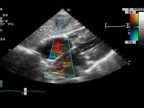 TTE Subcostal IAS Color Example 1 - YouTube