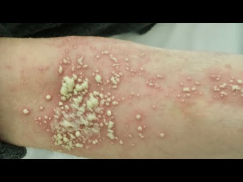 How To Treat Pustular Psoriasis - YouTube