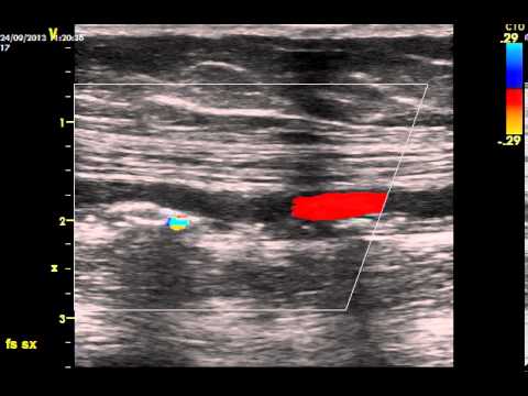 Femoral Artery Stenosis