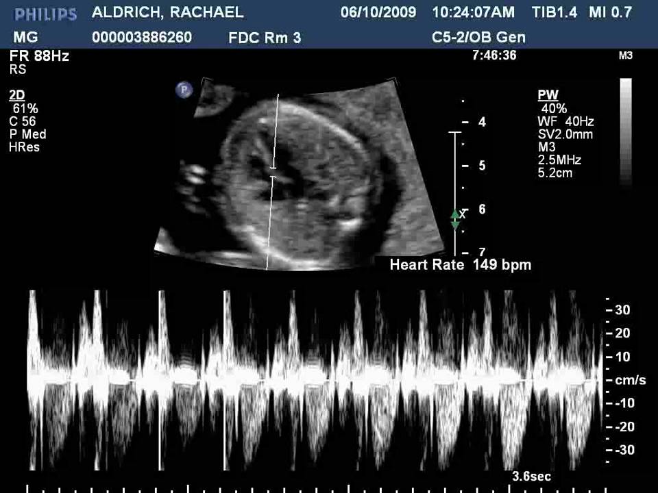 Fetal Heart Tones