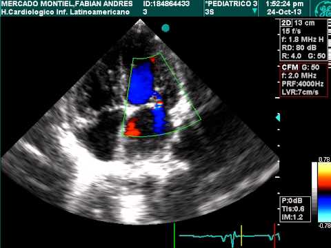 Estenosis mitral. Ecocardiografia infantil - YouTube