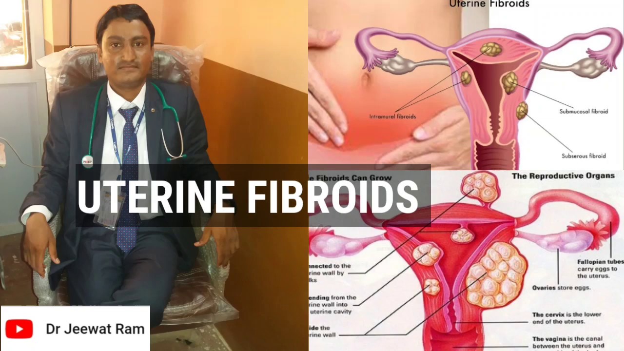 UTERINE FIBROIDS, CAUSES,SIGNS, SYMPTOMS, DIAGNOSIS AND MANAGEMENT ...