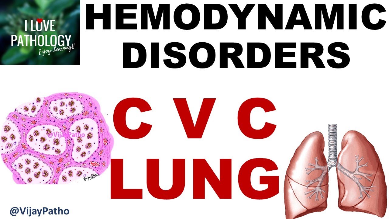 Chronic Venous Congestion - LUNG: Pathogenesis, Gross & Microscopy ...