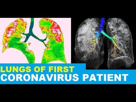 What is dead space of lungs - chickspana