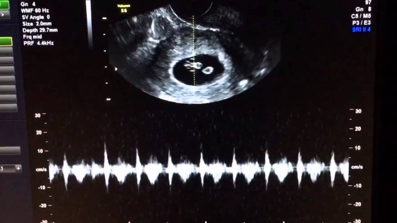 Fetal heartbeat doppler - sonryte