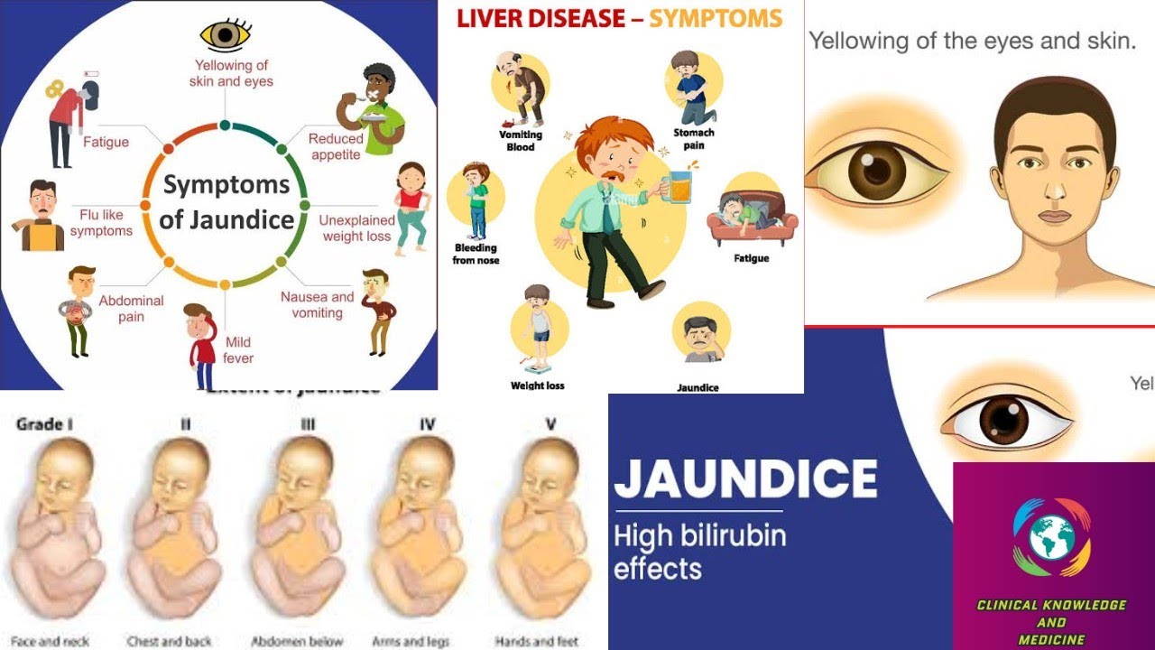 Jaundice | Definition, Causes, Signs and Symptoms, Investigation and ...