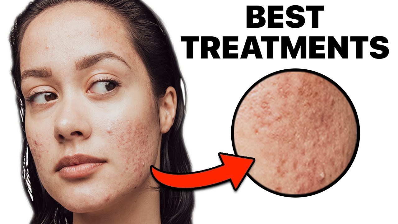 How To Get Rid of Acne Scars