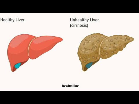 4 - Cirrhosis - YouTube