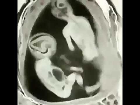 Rare videos of twins fighting in the womb - YouTube