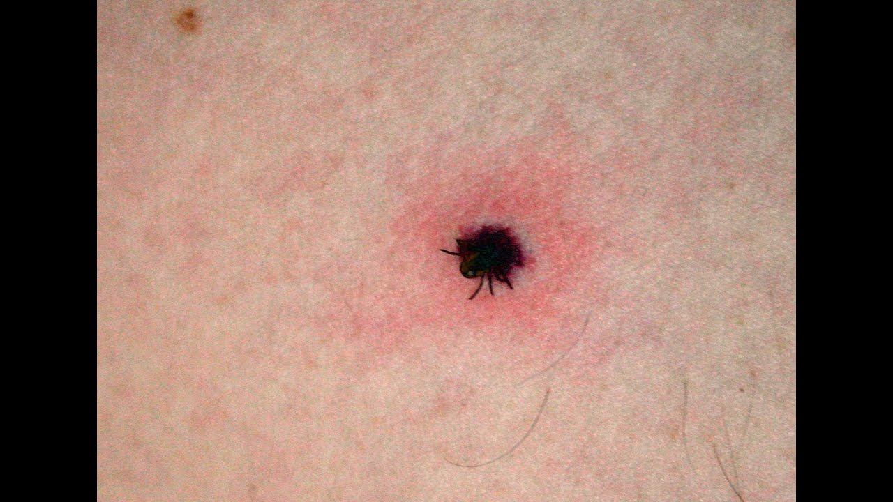 Tick Removal