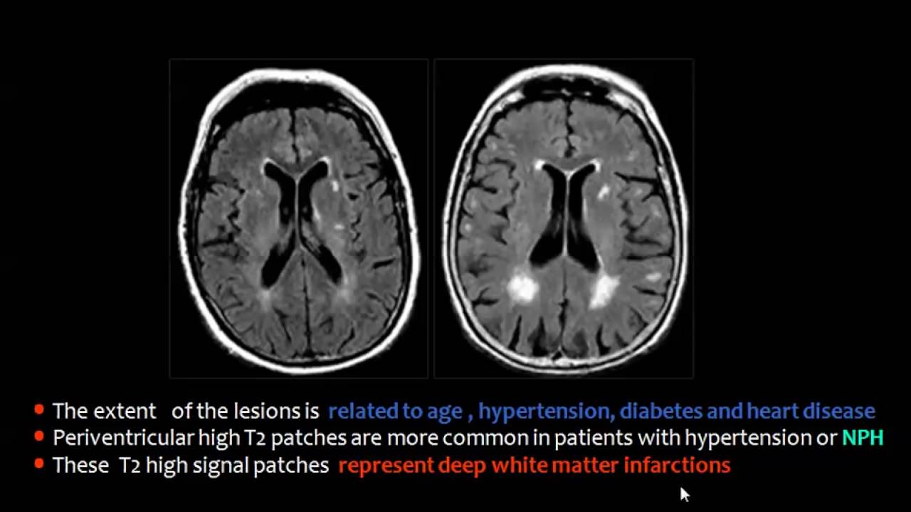 Imaging of White matter diseases II DRE 11 Dr Mamdouh Mahfouz 720p ...