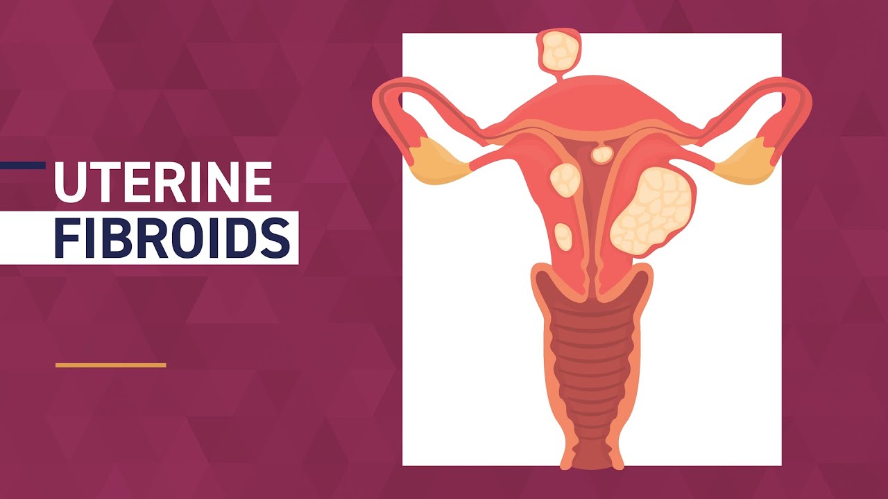 Fibroid Awareness Month | Common Fibroid Symptoms - YouTube